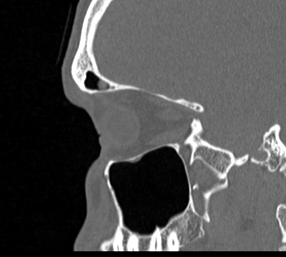 Angular epidermoid cyst (Radiopaedia 46908-51439 Sagittal bone window 65).png