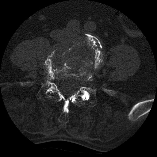 Ankylosing spondylitis complicated by fracture-dislocation (Radiopaedia 33583-34674 Axial non-contrast 115).jpg