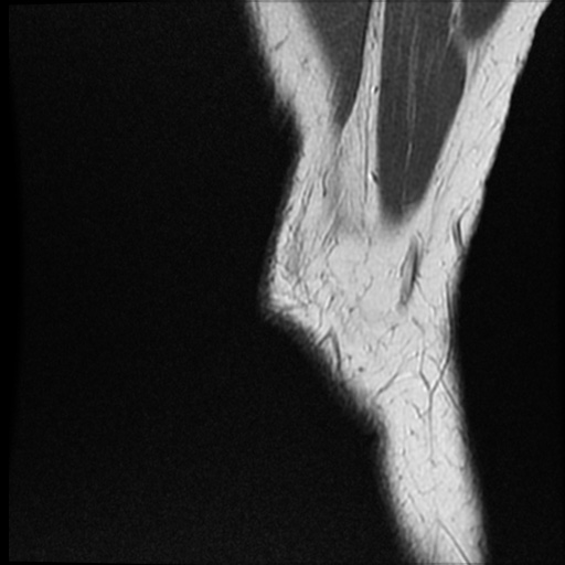 Anomalous insertion of the medial meniscus (Radiopaedia 77559-89721 Sagittal PD 52).jpg