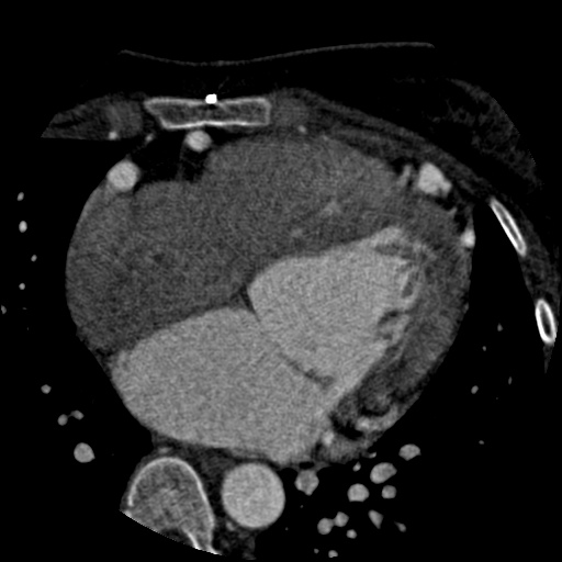 Anomalous left coronary artery from the pulmonary artery (ALCAPA) (Radiopaedia 40884-43586 A 42).jpg