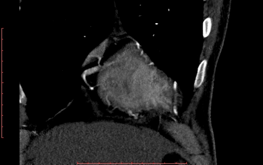 Anomalous left coronary artery from the pulmonary artery (ALCAPA) (Radiopaedia 70148-80181 B 52).jpg