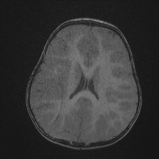 File:Anoxic brain injury (Radiopaedia 79165-92139 Axial MRA 163).jpg