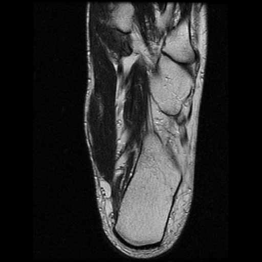 File:Anterior calcaneal process fracture (Radiopaedia 74654-85611 Axial T2 24).jpg