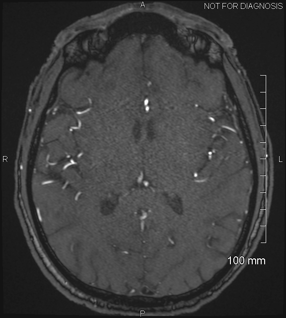 Anterior cerebral artery aneurysm (Radiopaedia 80683-94127 Axial MRA 135).jpg