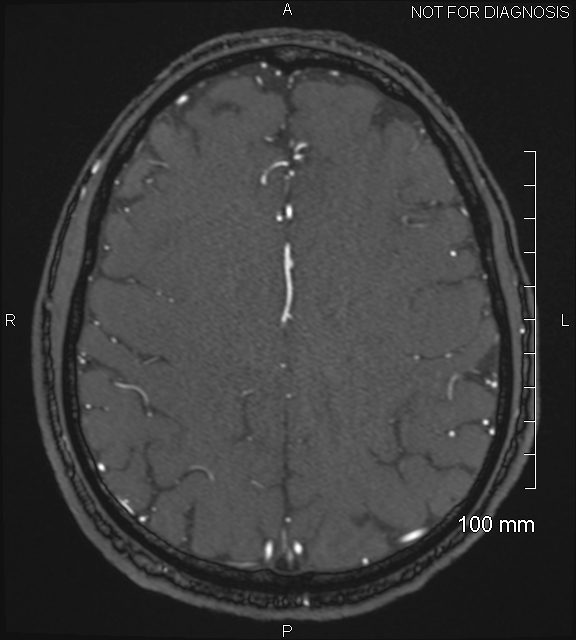 Anterior cerebral artery aneurysm (Radiopaedia 80683-94127 Axial MRA 178).jpg