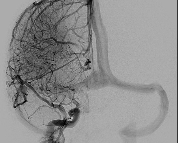 File:Anterior cerebral artery aneurysm (Radiopaedia 80683-94128 A 9).jpg