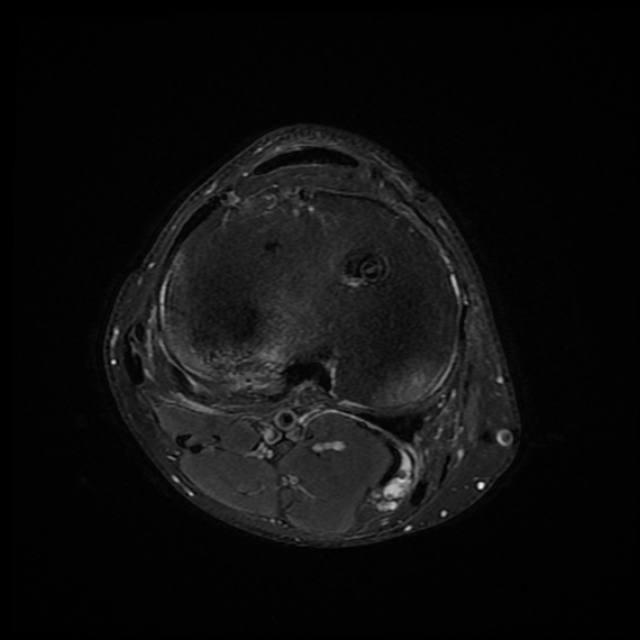 File:Anterior cruciate ligament graft tear and bucket-handle tear of medial meniscus (Radiopaedia 75867-87254 Axial PD fat sat 8).jpg