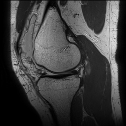 Anterior cruciate ligament rupture with Segond fracture (Radiopaedia 69043-78806 Sagittal PD 72).jpg