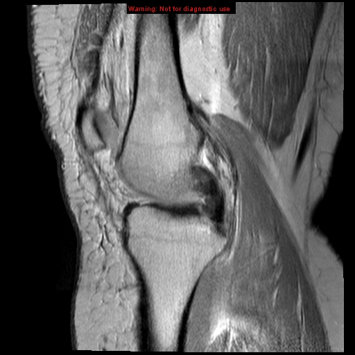 File:Anterior cruciate ligament tear (Radiopaedia 12329-12612 Sagittal T2 fat sat 13).jpg