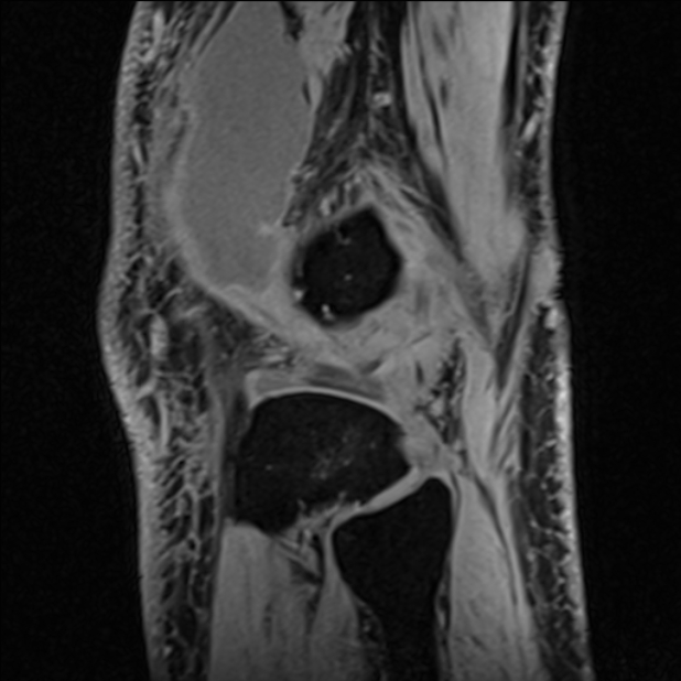 Anterior cruciate ligament tear - ramp lesion (Radiopaedia 71883-82322 Sagittal T1 vibe 25).jpg