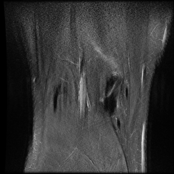 File:Anterior cruciate ligament tear with posteromedial corner injury, bucket-handle meniscal tear and chondral delamination (Radiopaedia 75501-86744 Coronal PD fat sat 23).jpg
