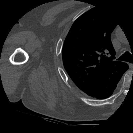 Anterior glenohumeral dislocation with Hill-Sachs lesion (Radiopaedia 62877-71249 Axial bone window 78).jpg