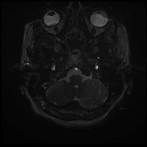 Anterior inferior cerebellar artery vascular loop - type II (Radiopaedia 70991-81209 Axial 3D FIESTA 73).jpg