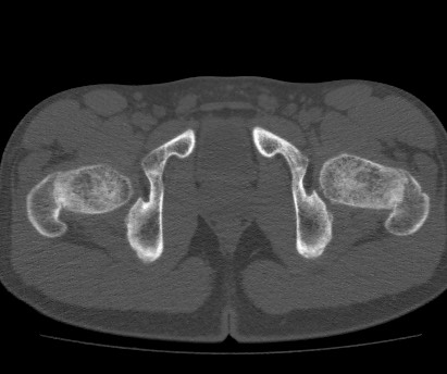 Anterior inferior iliac spine avulsion fracture (Radiopaedia 81312-94999 Axial bone window 61).jpg