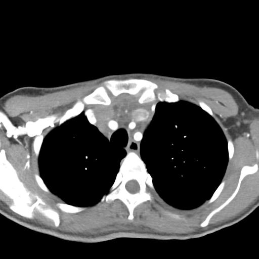 Anterior mediastinal lymphoma (Radiopaedia 29556-30061 C 12).jpg