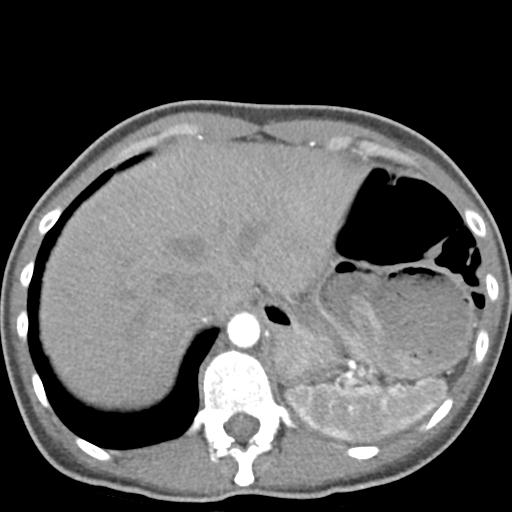 File:Anterior mediastinal lymphoma (Radiopaedia 29556-30061 C 50).jpg
