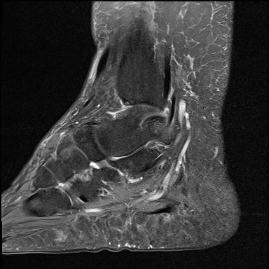 File:Anterior talofibular ligament injury - rupture with soft-tissue impingement (Radiopaedia 38765-40928 Sagittal PD fat sat 6).jpg