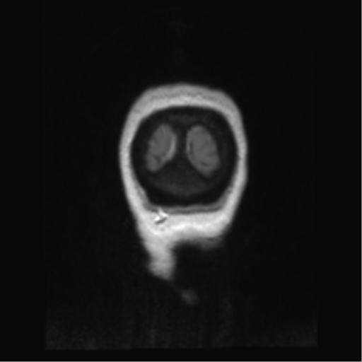 Anterior temporal pole cysts (Radiopaedia 46629-51102 Coronal T1 C+ 3).png
