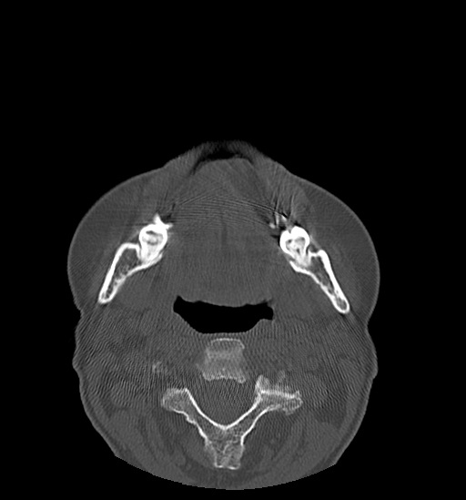 Anterior temporomandibular joint dislocation (Radiopaedia 59430-66784 Axial non-contrast 41).jpg