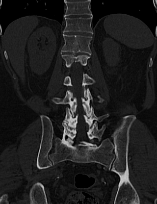 File:Anterior vertebral scalloping (abdominal aortic aneurysm) (Radiopaedia 66744-76067 Coronal bone window 48).jpg