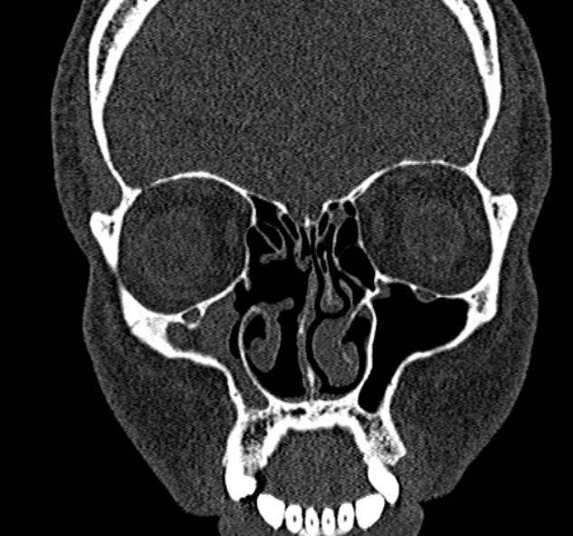 Antrochoanal polyp (Radiopaedia 30002-30554 Coronal bone window 30).jpg