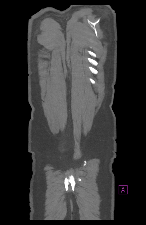 Aortectomy and axillary-bifemoral bypass (Radiopaedia 28303-28545 C 87).jpg