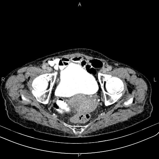 File:Aortic aneurysm and Lemmel syndrome (Radiopaedia 86499-102554 Axial C+ delayed 72).jpg