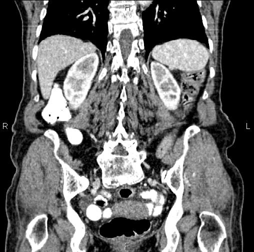 Aortic aneurysm and Lemmel syndrome (Radiopaedia 86499-102554 C 48).jpg