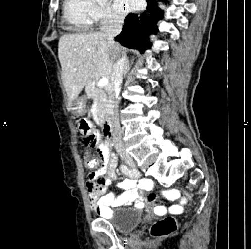 Aortic aneurysm and Lemmel syndrome (Radiopaedia 86499-102554 D 39).jpg