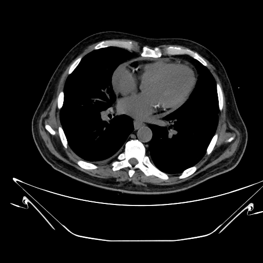 Aortic arch aneurysm (Radiopaedia 84109-99365 Axial non-contrast 167).jpg