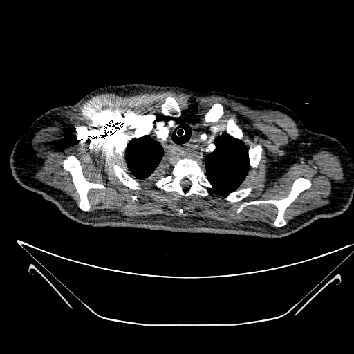 Aortic arch aneurysm (Radiopaedia 84109-99365 B 95).jpg