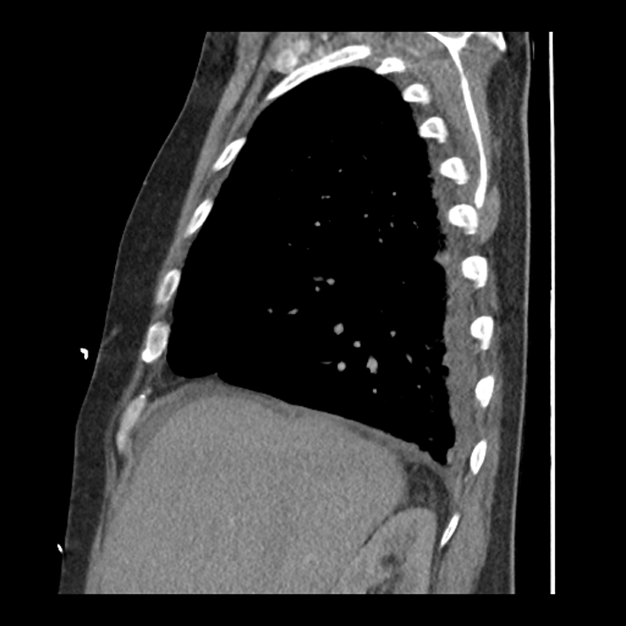 Aortic arch graft infection (FDG PET-CT) (Radiopaedia 71975-82437 C 16).jpg