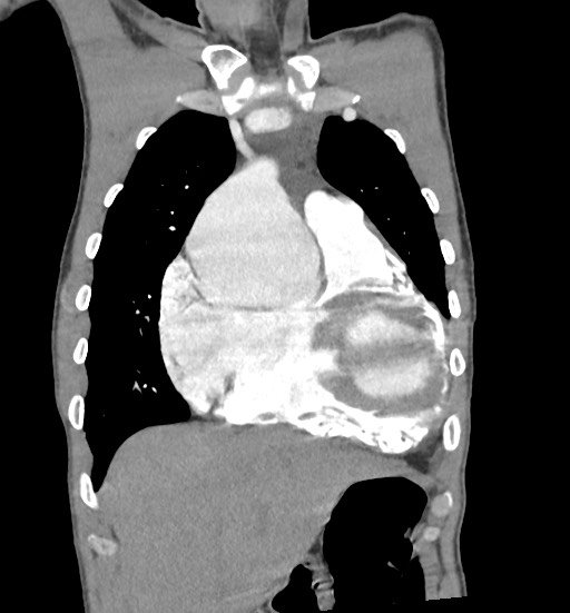 File:Aortic coarctation with aneurysm (Radiopaedia 74818-85828 C 30).jpg