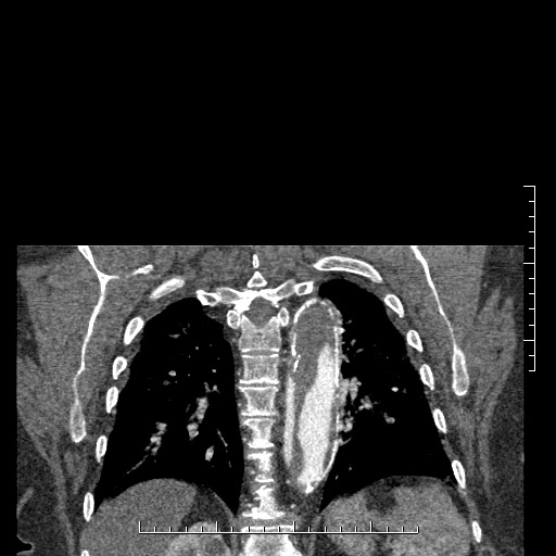 Aortic dissection- Stanford A (Radiopaedia 35729-37268 E 1).jpg