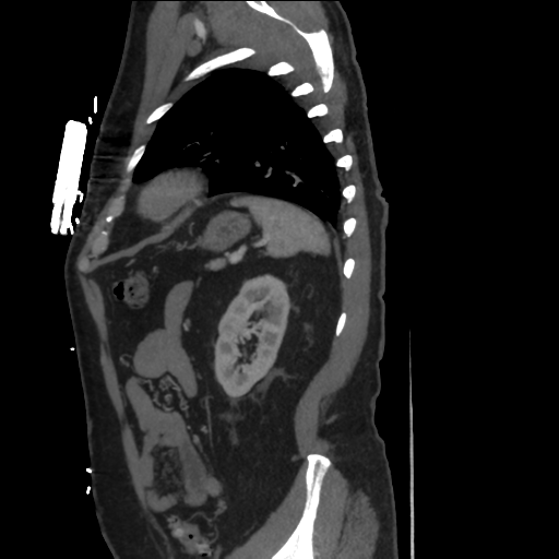 File:Aortic dissection- Stanford A (Radiopaedia 37759-39664 Sagittal C+ delayed 39).png