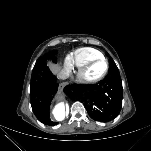 Aortic dissection (Radiopaedia 27466-27665 C+ arterial phase 221).jpg
