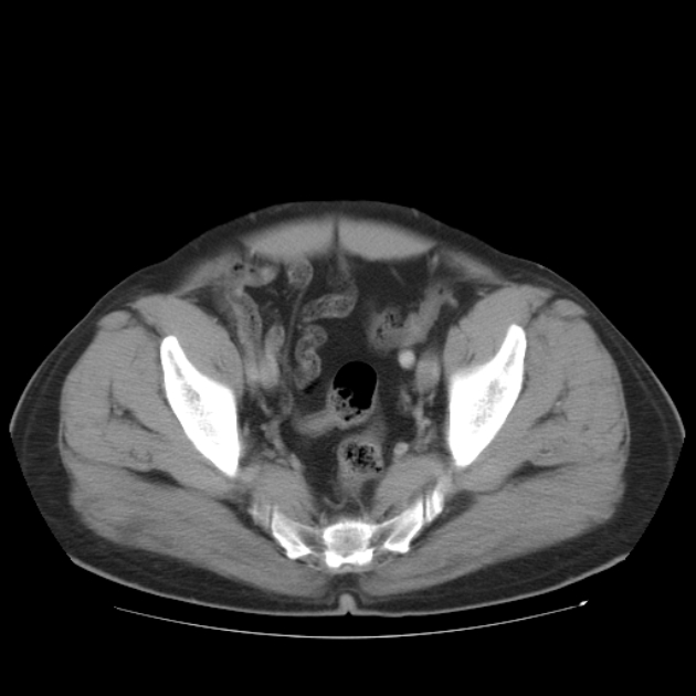 Aortic dissection (Radiopaedia 44411-48061 C 98).jpg