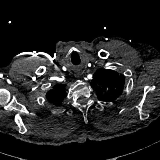 File:Aortic dissection - DeBakey type II (Radiopaedia 64302-73082 A 10).png