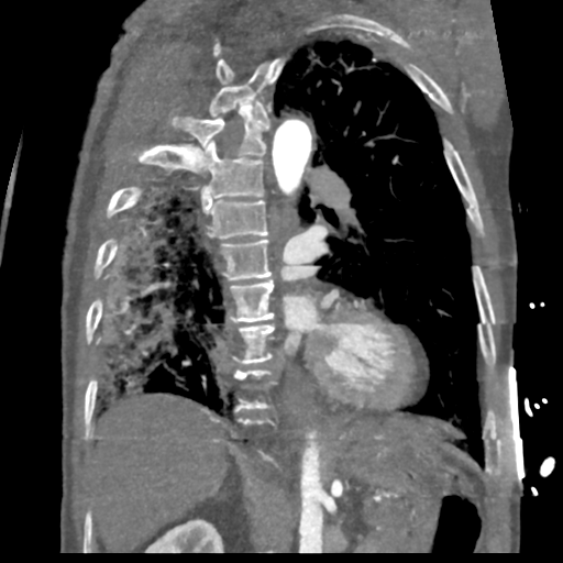 File:Aortic dissection - DeBakey type II (Radiopaedia 64302-73082 D 27).png