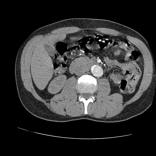 File:Aortic dissection - Stanford A -DeBakey I (Radiopaedia 28339-28587 B 139).jpg