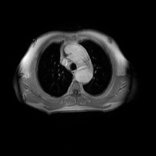 File:Aortic dissection - Stanford A - DeBakey I (Radiopaedia 23469-23551 Axial MRA 10).jpg
