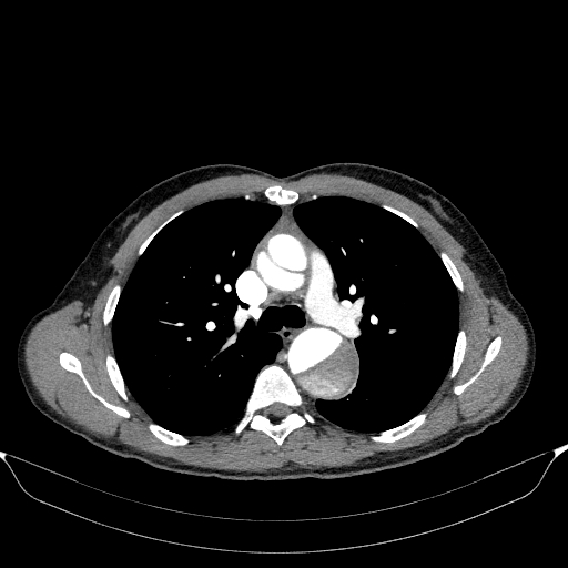 Aortic dissection - Stanford type A (Radiopaedia 83418-98500 A 26).jpg