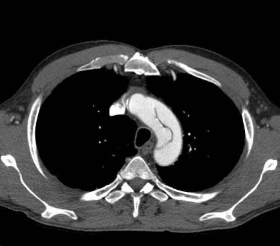 Aortic dissection - Stanford type B (Radiopaedia 73648-84437 A 17).jpg