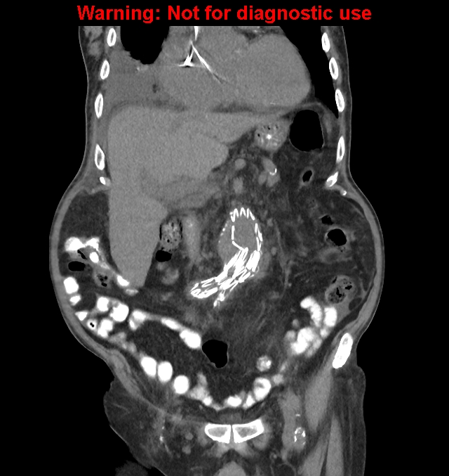 Aortic graft infection (Radiopaedia 44979-48907 non-contrast 20).jpg