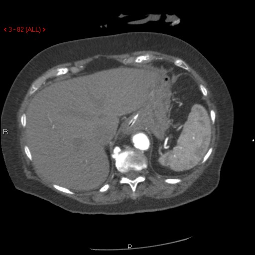 File:Aortic intramural hematoma (Radiopaedia 27746-28001 A 82).jpg