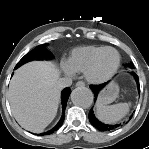 Aortic intramural hematoma (Radiopaedia 31139-31838 Axial non-contrast 43).jpg