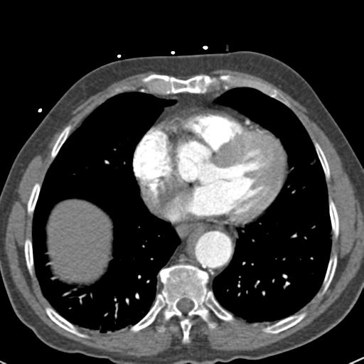 Aortic intramural hematoma (Radiopaedia 31139-31838 B 60).jpg