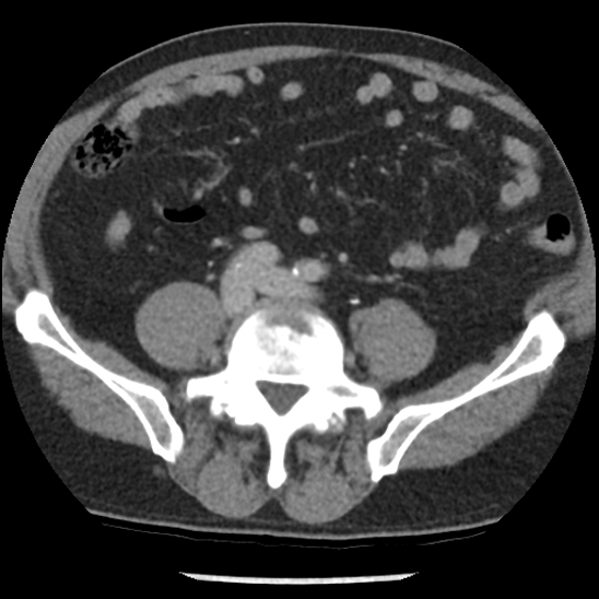 File:Aortic intramural hematoma (type B) (Radiopaedia 79323-92387 Axial C+ delayed 86).jpg