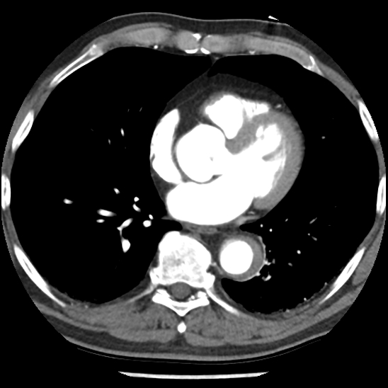 Aortic intramural hematoma (type B) (Radiopaedia 79323-92387 B 34).jpg