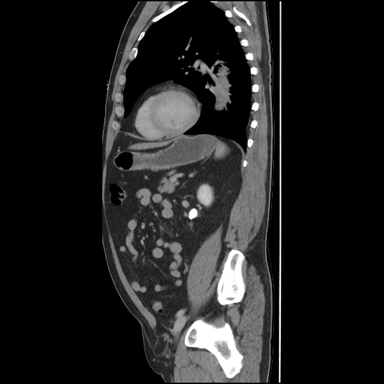 Aortic intramural hematoma (type B) (Radiopaedia 79323-92387 Sagittal C+ delayed 37).jpg